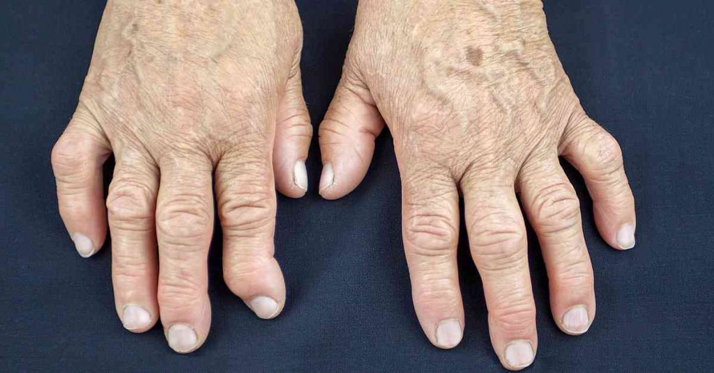 Natural Remedies for Arthritis