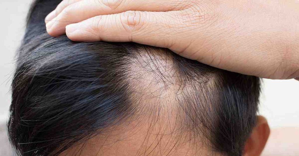 How to Prevent Hair Loss