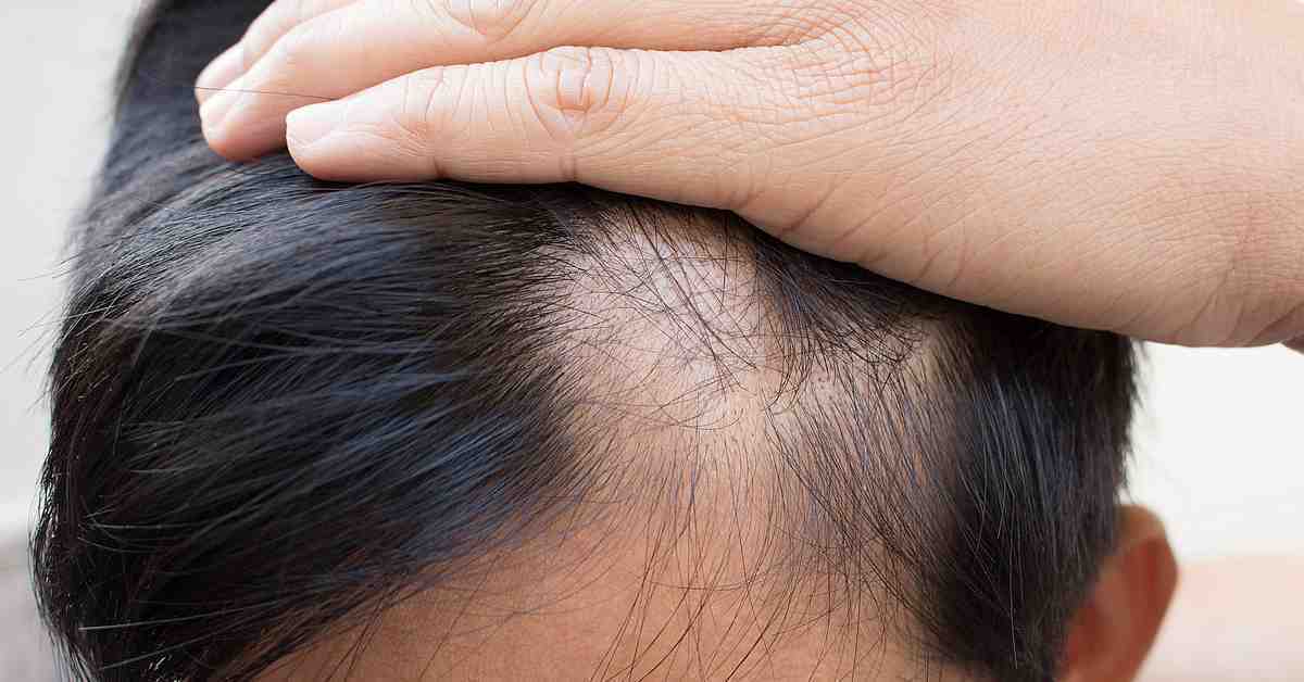 How to Prevent Hair Loss