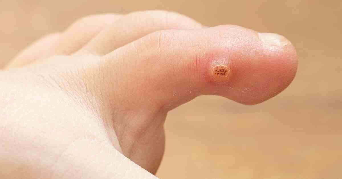 How to Get Rid of Warts